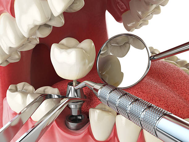 Best Knocked-Out Tooth (Avulsed Tooth) Treatment in Jefferson, OR